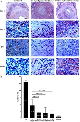 Glucocorticoid Effects on Tissue Residing Immune Cells in Giant Cell Arteritis: Importance of GM-CSF